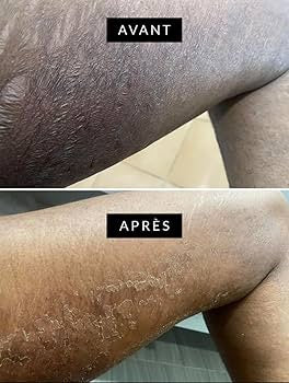 Lait peeling urgence 🚨
