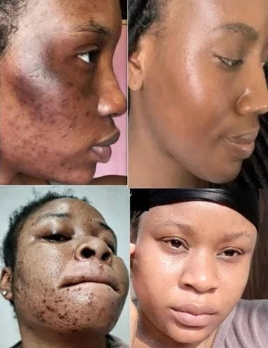Lait peeling urgence 🚨